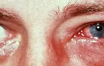 Kış aylarında göz enfeksiyonlarına dikkat