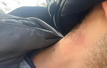 Kopan elektrik teli motosiklet sürücüsünü yaraladı