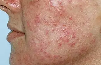 Uzmanlar kış aylarında görülen cilt hastalıklarına dikkat çekti