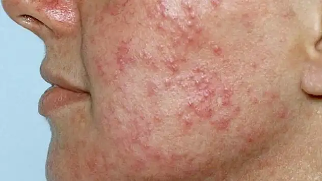 Uzmanlar kış aylarında görülen cilt hastalıklarına dikkat çekti