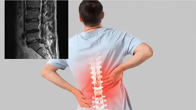 Bel fıtığı alarm veriyor ağrı ve uyuşmaya dikkat