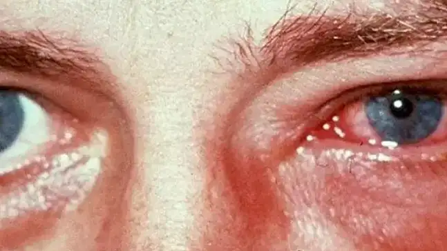 Kış aylarında göz enfeksiyonlarına dikkat