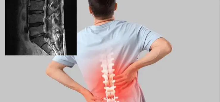 Bel fıtığı alarm veriyor ağrı ve uyuşmaya dikkat