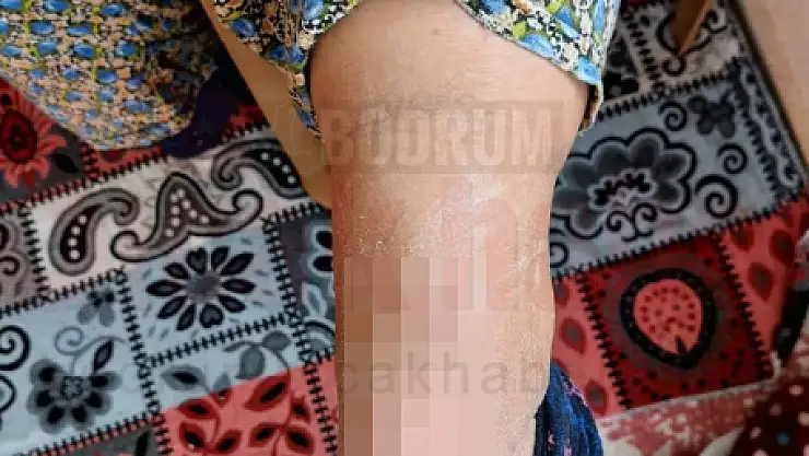 Ayak Topuğundan 37 Santim Tel Çıktı