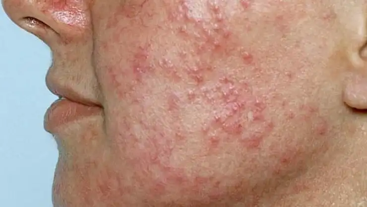 Uzmanlar kış aylarında görülen cilt hastalıklarına dikkat çekti