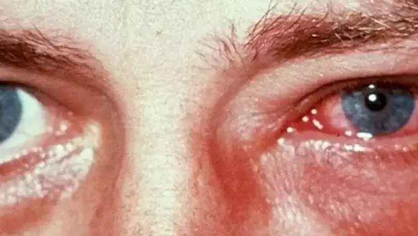 Kış aylarında göz enfeksiyonlarına dikkat