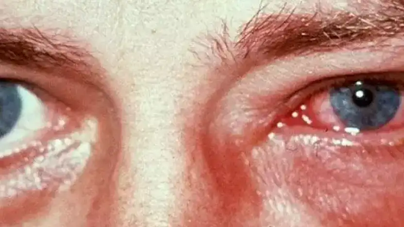 Kış aylarında göz enfeksiyonlarına dikkat
