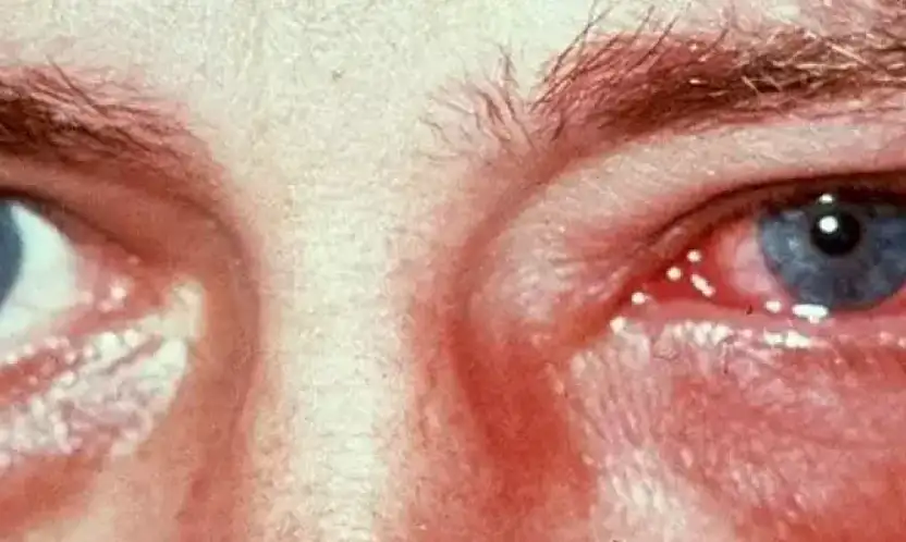 Kış aylarında göz enfeksiyonlarına dikkat